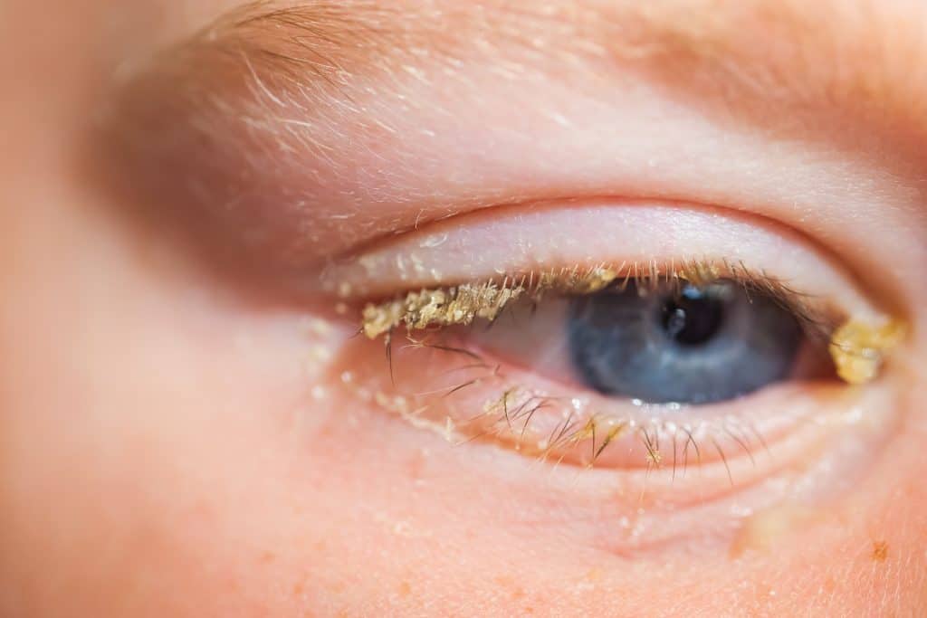 Total optical Purulent,Conjunctivitis,In,Children